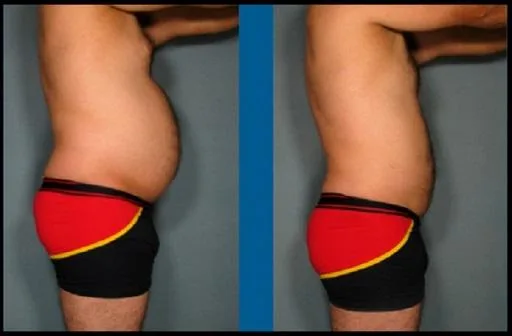 Body lift Miami - Dr. Ramirez Plastic Surgeon