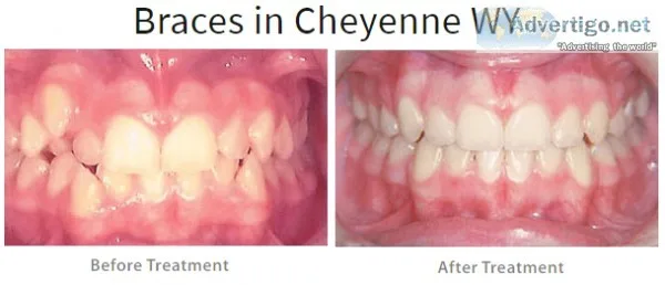 How to Keep Good Oral Hygiene with Braces 2020 Braces Wyoming
