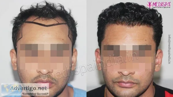 Get the best FUT Hair Transplant in India at Medispa by Dr. Sune