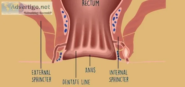Best fistula Ayurvedic Doctor in Delhi NCR  Ayurvedic Fistula Tr