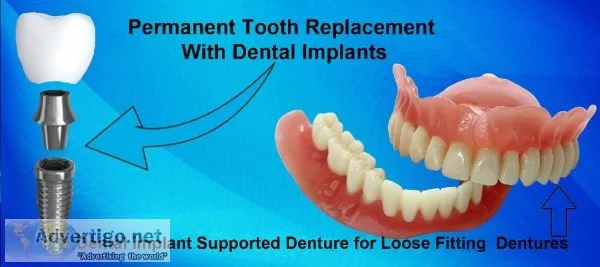 Find one of the best dental implants in Kolkata  - Teeth care Mu