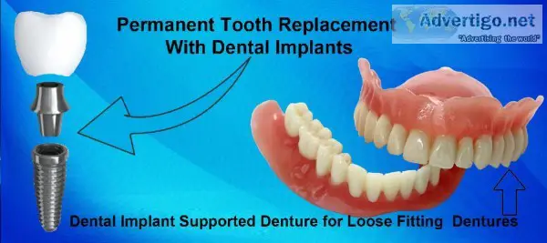 Choose  best dental implant clinic in kolkata to solve your dent