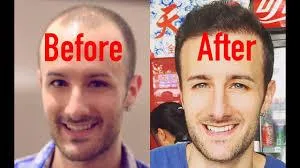 HAIR RESTORATION IN MUMBAI