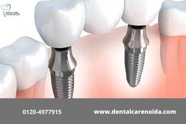 Dental Implants in Noida - Trust Our Experienced Dentists