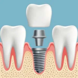 Beautiful Artificial teeth insert to give you the healthy smile.