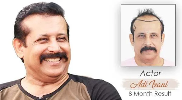 Check out the Celebrity Hair Transplant at Medispa by Dr. Suneet