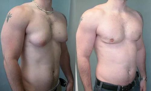 Laser Treatment For Gynecomastia In Delhi