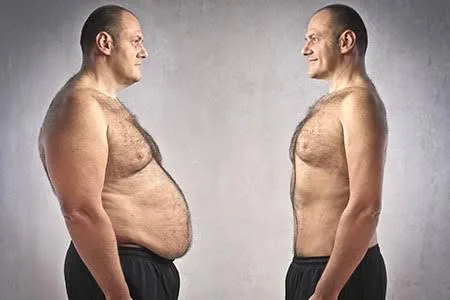 Shed The Pounds With Bariatic Surgery In Kolkata