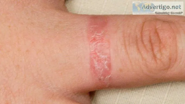 Consult with a dermatologist and get away from dermatitis