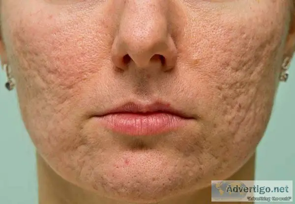 Best Doctor for Acne Scar Treatment in Meerut