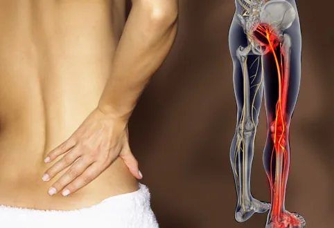 What causes sciatica