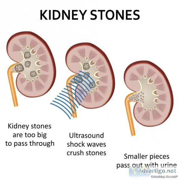 what is kidney stone and how to cure it with ayurvedic medicine