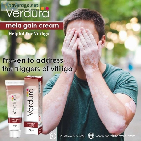 Cream For Vitiligo and Skin Pigmentation