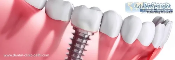 The Best Quality Basal Dental Implants