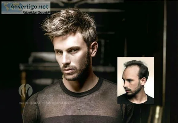 Hair Replacement for Men &ndash Minneapolis St. Paul