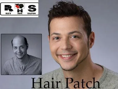 Hair Weaving Treatment  Beard Transplant Cost