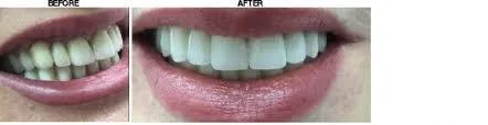 Transform your smile with dental implants New York