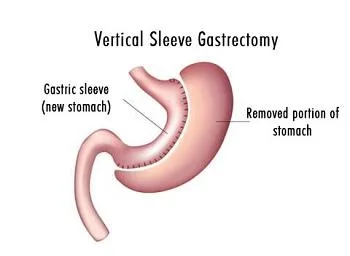 Gastric Sleeve Surgery Mexico