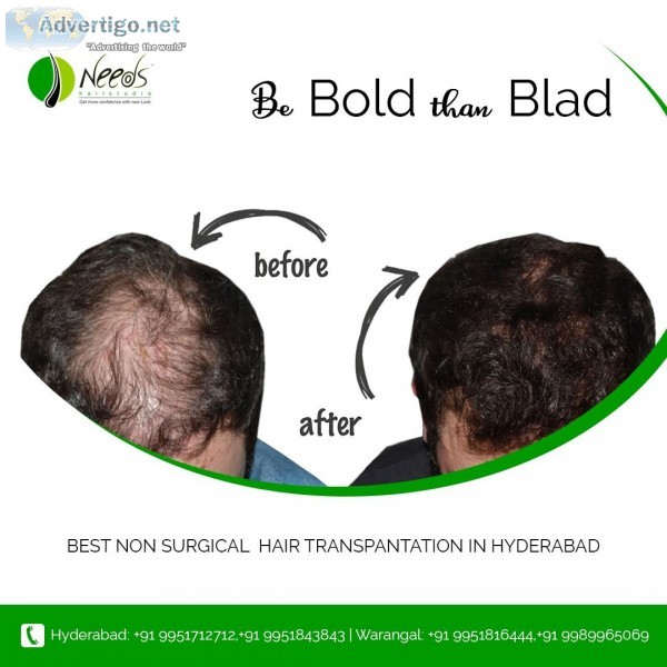 best non surgical hair replacement for men