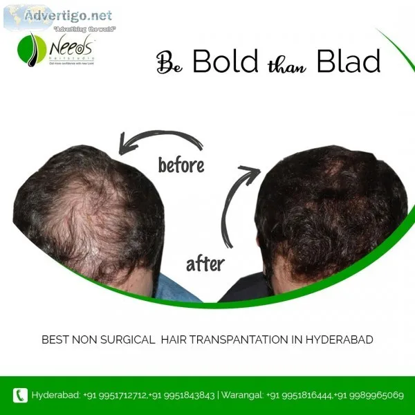 best non surgical hair replacement for men