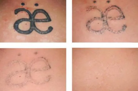 Tattoo Removal In Bhubaneswar