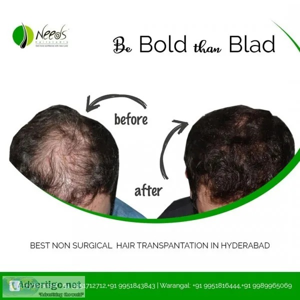 best non surgical hair replacement
