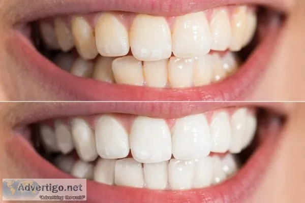 Teeth Whitening in Miami