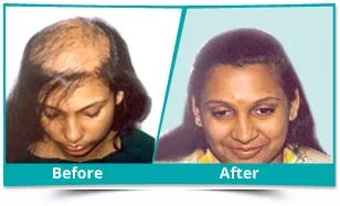 Best Hair Transplant in Delhi