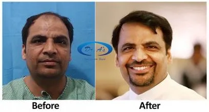 Hair Transplant in Mumbai