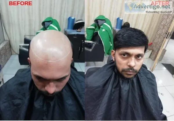 Hair Patch in Gurgaon