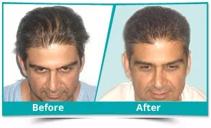 Best Hair Transplant in Mumbai