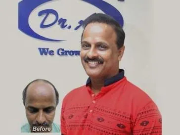 Hair Transplant in Delhi
