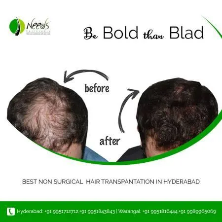 advanced medical hair replacement