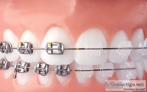 Best FIXED ORTHODONTICS Course In Hyderabad
