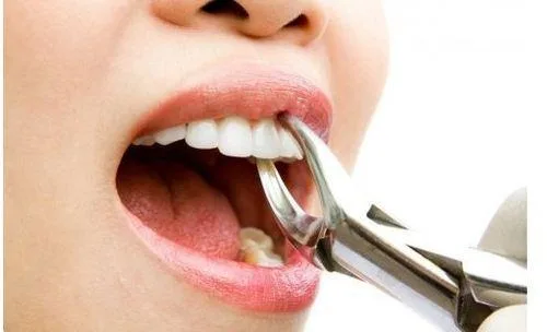 Tooth Fillings Arlington VA