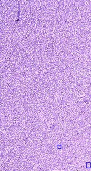 Best Hematology slides services in Delhi India