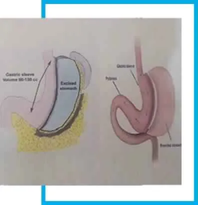 Laparoscopic obesity/ bariatric/ weight loss surgery & treatment