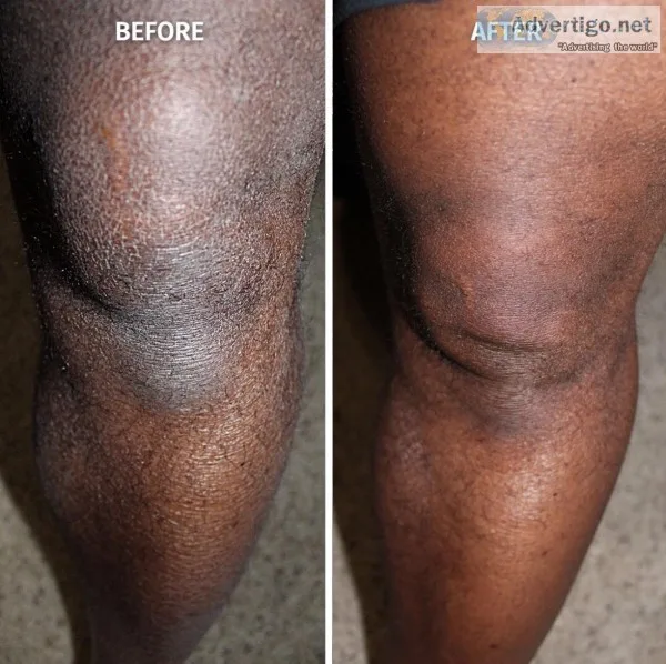 Dry Skin Relief