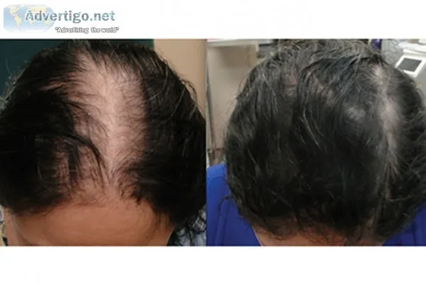 Help for Hair Loss &ndash an Effective Hair Loss Solution