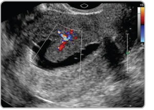 Sonohysterography
