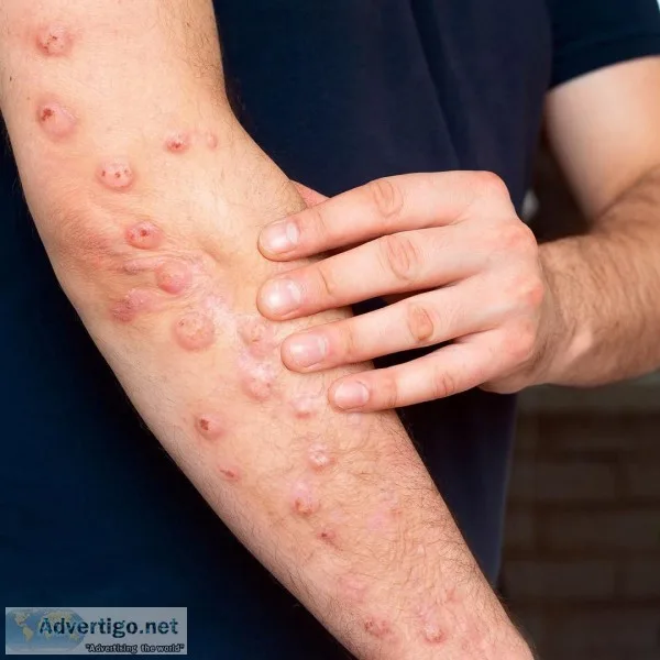 Are you suffering from chronic severe itch with bumps on the ski