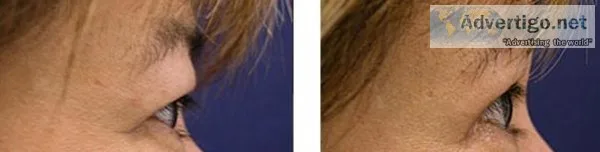 Advanced Eyelid Surgery
