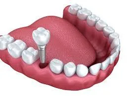 5 AFTER CARE TIPS FOR YOUR DENTAL IMPLANTS
