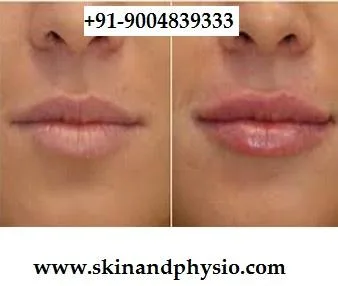 TREATMENT FOR LIP AUGMENTATION