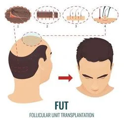Know about FUT Hair Transplant at Medispa Clinic