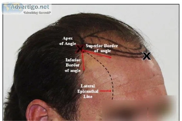 Get Natural Hairline Design by Hair Transplant at Medispa