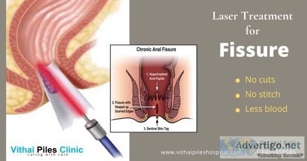 Laser Treatment for Fissure in Pune