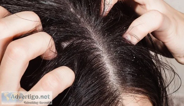 SMUK Provide Best Dandruff Treatment in India