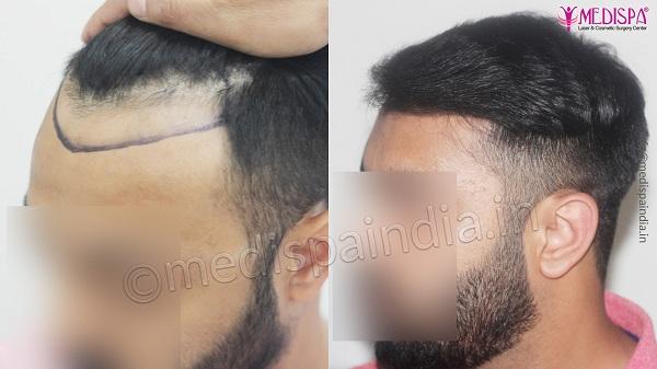 Avail Best Hair Transplant Surgery by Dr. Suneet Soni