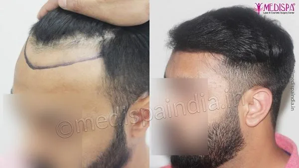 Avail Best Hair Transplant Surgery by Dr. Suneet Soni
